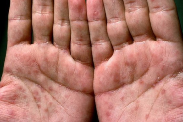 HIV and AIDS Treatment Badlapur