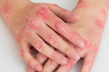 Leprosy Treatment - Kshitij Skin Clinic